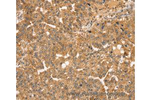 Immunohistochemistry of Human breast cancer using STX10 Polyclonal Antibody at dilution of 1:35 (Syntaxin 10 antibody)