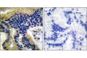 Immunohistochemistry analysis of paraffin-embedded human lung carcinoma tissue, using Caspase 9 (Cleaved-Asp330) Antibody. (Caspase 9 antibody  (Cleaved-Asp330))