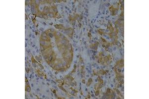 Immunohistochemistry of paraffin-embedded human gastric cancer using BIN1 Antibody (ABIN3022553, ABIN3022554, ABIN1678863 and ABIN6218901) at dilution of 1:200 (40x lens). (BIN1 antibody  (AA 230-409))