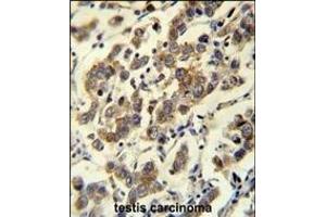 MBD3L3 Antibody (C-term) (ABIN656066 and ABIN2845416) immunohistochemistry analysis in formalin fixed and paraffin embedded human testis carcinoma followed by peroxidase conjugation of the secondary antibody and DAB staining. (MBD3L3 antibody  (C-Term))