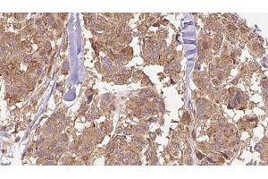 ABIN6274897 at 1/100 staining Human Melanoma tissue by IHC-P. (EPB41L2 antibody  (Internal Region))