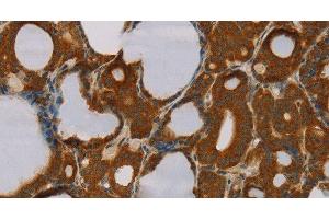 Immunohistochemistry of paraffin-embedded Human thyroid cancer tissue using PARP3 Polyclonal Antibody at dilution 1:40 (PARP3 antibody)