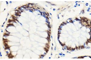 Immunohistochemistry of paraffin-embedded Human colon carcinoma using SNIP1 Polyclonal Antibody at dilution of 1:100 (40x lens). (SNIP1 antibody)