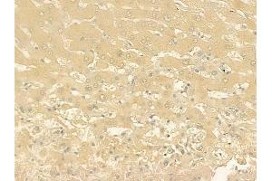 ABIN6261684 and ABIN6276377 at 1/100 staining human hepatocellular carcinoma by IHC-P. (Fatty Acid Synthase antibody  (N-Term))