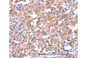 Immunohistochemistry of Human thyroid cancer using FAT1 Polyclonal Antibody at dilution of 1:40 (FAT1 antibody)
