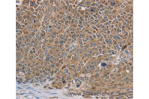 Immunohistochemistry of Human ovarian cancer using NDUFS7 Polyclonal Antibody at dilution of 1:40 (NDUFS7 antibody)