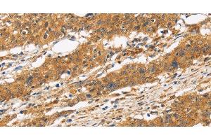 Immunohistochemistry of paraffin-embedded Human gasrtic cancer tissue using CD22 Polyclonal Antibody at dilution 1:50 (CD22 antibody)