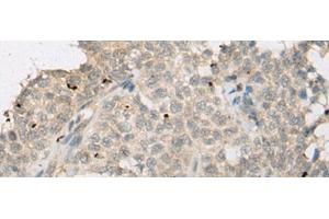 Immunohistochemistry of paraffin-embedded Human ovarian cancer tissue using ZNF449 Polyclonal Antibody at dilution of 1:50(x200) (ZNF449 antibody)