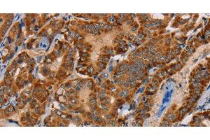 Immunohistochemistry of paraffin-embedded Human thyroid cancer tissue using MBNL3 Polyclonal Antibody at dilution 1:30 (MBNL3 antibody)