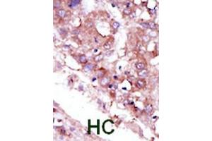 Formalin-fixed and paraffin-embedded human cancer tissue reacted with the primary antibody, which was peroxidase-conjugated to the secondary antibody, followed by DAB staining. (STK33 antibody  (C-Term))