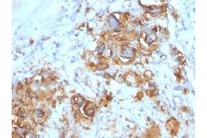 Formalin-fixed, paraffin-embedded human gastric carcinoma stained with CA19-9 antibody (121SLE). (CA 19-9 antibody)