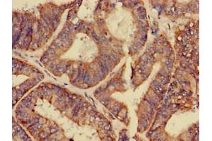 Immunohistochemistry of paraffin-embedded human endometrial cancer using ABIN7154155 at dilution of 1:100 (GPAM antibody  (AA 281-459))