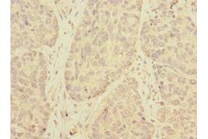Immunohistochemistry of paraffin-embedded human ovarian cancer using ABIN7173139 at dilution of 1:100 (FAM156A antibody  (AA 251-519))