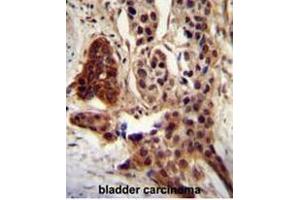 CCDC122 antibody (C-term) immunohistochemistry analysis in formalin fixed and paraffin embedded human bladder carcinoma followed by peroxidase conjugation of the secondary antibody and DAB staining. (CCDC122 antibody  (C-Term))