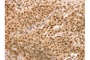 The image on the left is immunohistochemistry of paraffin-embedded Human breast cancer tissue using ABIN7131133(SNX8 Antibody) at dilution 1/25, on the right is treated with fusion protein.
