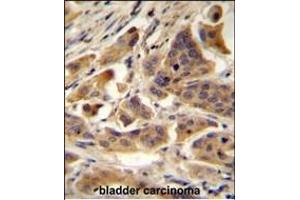 RBCK1 (UBCE7IP3) Antibody (N-term) A immunohistochemistry analysis in formalin fixed and paraffin embedded human bladder carcinoma followed by peroxidase conjugation of the secondary antibody and DAB staining. (RBCK1 antibody  (N-Term))