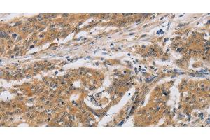 Immunohistochemistry of paraffin-embedded Human ovarian cancer tissue using CST6 Polyclonal Antibody at dilution 1:30 (CST6 antibody)
