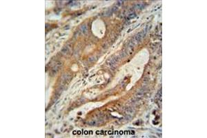 ZBBX antibody (N-term) immunohistochemistry analysis in formalin fixed and paraffin embedded human colon carcinoma followed by peroxidase conjugation of the secondary antibody and DAB staining. (ZBBX antibody  (N-Term))