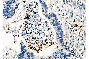 ABIN6261740 and ABIN6278462 at 1/100 staining Human colorectal cancer by IHC-P. (FGL2 antibody  (C-Term))