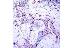 Immunohistochemical analysis of paraffin- embedded human breast carcinoma tissue, using Progesterone Receptor (phospho-Ser190) antibody (E011074). (Progesterone Receptor antibody  (pSer190))