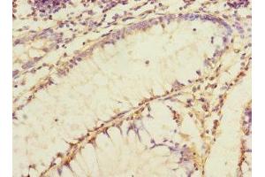 Immunohistochemistry of paraffin-embedded human colon cancer using ABIN7156093 at dilution of 1:100