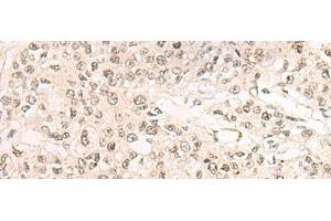 Immunohistochemistry of paraffin-embedded Human prost ate cancer tissue using WEE1 Polyclonal Antibody at dilution of 1:35(x200) (WEE1 antibody)