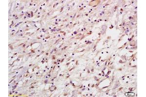 Formalin-fixed and paraffin embedded human gastric carcinoma labeled with Anti-HPV33 E7 Polyclonal Antibody, Unconjugated (ABIN872449) at 1:200, followed by conjugation to the secondary antibody and DAB staining (Human Papilloma Virus 33 E7 (HPV-33 E7) (AA 41-97) antibody)
