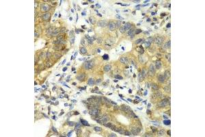Immunohistochemistry of paraffin-embedded human gastric cancer using DPP3 antibody. (DPP3 antibody  (AA 1-280))