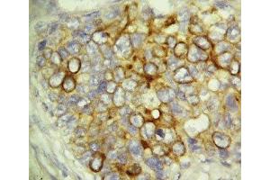 IHC-P: Caspase-6 antibody testing of human breast cancer tissue