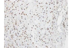 IHC-P Image Immunohistochemical analysis of paraffin-embedded A549 xenograft, using LZIP, antibody at 1:100 dilution. (CREB3 antibody  (C-Term))