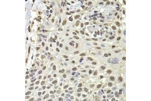 Immunohistochemistry of paraffin-embedded human well-differentiated squamous skin carcinoma using PUF60 antibody (ABIN5974052) at dilution of 1/100 (40x lens). (PUF60 antibody)