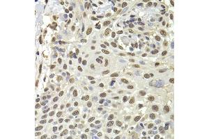 Immunohistochemistry of paraffin-embedded human well-differentiated squamous skin carcinoma using PUF60 antibody (ABIN5974052) at dilution of 1/100 (40x lens).