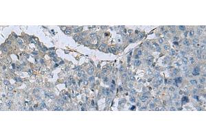 Immunohistochemistry of paraffin-embedded Human liver cancer tissue using GLS Polyclonal Antibody at dilution of 1:70(x200) (Glutaminase antibody)