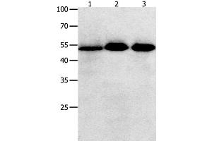 Western Blot analysis of Human lymphoma , ovarian and colon cancer tissue using KLF5 Polyclonal Antibody at dilution of 1:350 (KLF5 antibody)