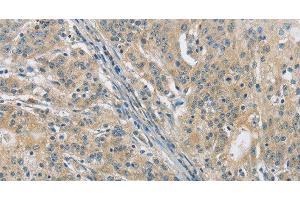 Immunohistochemistry of paraffin-embedded Human gasrtic cancer tissue using PKD1 Polyclonal Antibody at dilution 1:40 (PKD1 antibody)