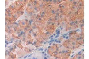 DAB staining on IHC-P; Samples: Human Stomach cancer Tissue (ICOS antibody  (AA 31-190))