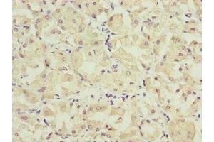 Immunohistochemistry of paraffin-embedded human gastric cancer using ABIN7157234 at dilution of 1:100 (KANSL3 antibody  (AA 1-200))