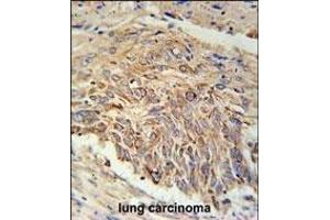 EBPL Antibody (C-term) (ABIN651922 and ABIN2840457) immunohistochemistry analysis in formalin fixed and paraffin embedded human lung carcinoma followed by peroxidase conjugation of the secondary antibody and DAB staining. (EBPL antibody  (C-Term))