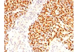 Formalin-fixed, paraffin-embedded human Rhabdomyosarcoma stained with Myogenin Mouse Monoclonal Antibody (F5D) (Myogenin antibody  (AA 30-224, AA 73-94, AA 138-158))