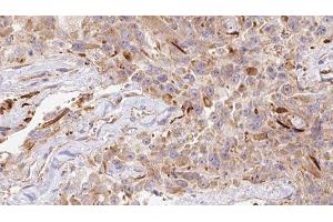 ABIN6278151 at 1/100 staining Human Melanoma tissue by IHC-P. (LGALS1/Galectin 1 antibody)