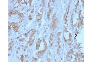 Formalin-fixed, paraffin-embedded human ovarian carcinoma stained. (TDRKH antibody)