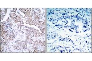 Immunohistochemistry analysis of paraffin-embedded human breast carcinoma, using p53 (Phospho-Ser15) Antibody.