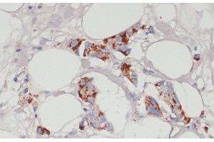 Immunohistochemistry of paraffin-embedded Human mammary cancer using ACSL3 Polyclonal Antibody at dilution of 1:100 (40x lens). (Acsl3 antibody)