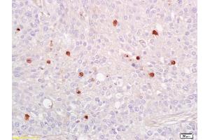 Formalin-fixed and paraffin embedded human lung carcinoma labeled with Anti-phospho-NFKB p65(Ser536) Polyclonal Antibody, Unconjugated (ABIN730528) at 1:200 followed by conjugation to the secondary antibody and DAB staining.