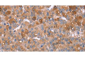 Immunohistochemistry of paraffin-embedded Human liver cancer tissue using GPC6 Polyclonal Antibody at dilution 1:40 (Glypican 6 antibody)