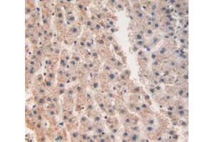 IHC-P analysis of Human Liver Cancer Tissue, with DAB staining. (CHI3L1 antibody  (AA 112-377))