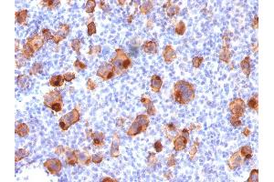 Formalin-fixed, paraffin-embedded human Hodgkin's Lymphoma stained with CD30 Mouse Recombinant Monoclonal Antibody (rKi-1/779). (Recombinant TNFRSF8 antibody)