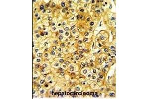 Formalin-fixed and paraffin-embedded human hepatocarcinoma with SRC Antibody , which was peroxidase-conjugated to the secondary antibody, followed by DAB staining. (Src antibody  (AA 397-424))