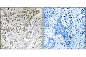 Immunohistochemistry analysis of paraffin-embedded human lung carcinoma tissue, using EFTUD2 Antibody. (EFTUD2 antibody  (AA 321-370))