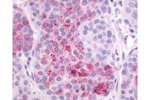 Anti-LPAR4 / GPR23 antibody IHC of human Ovary, Carcinoma. (LPAR4 antibody  (N-Term))